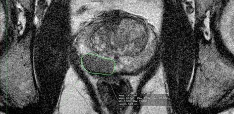 Biopsja celowana pod obrazem MRI