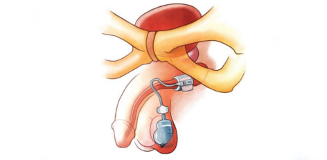 Artificial urinary sphincter